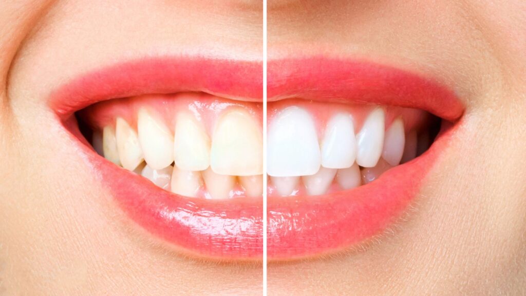 whitening treatment in Christchurch