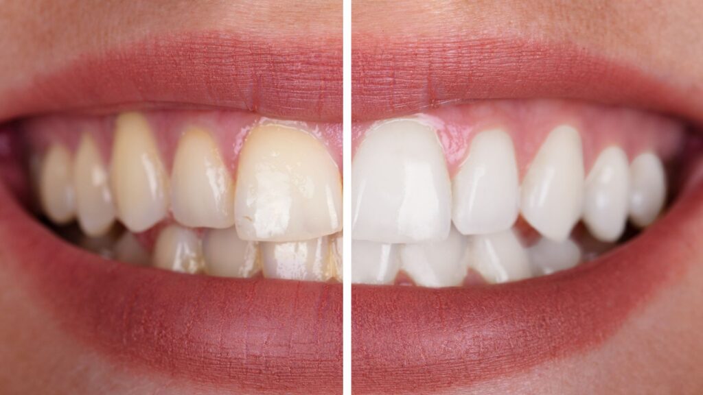 professional teeth whitening Christchurch NZ