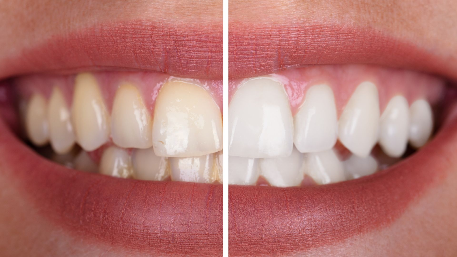 professional teeth whitening Christchurch NZ